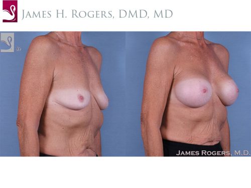 Breast Augmentation Case #63977 (Image 2)