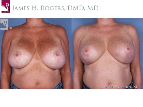Female Breast Reduction Case #13784 (Image 1)