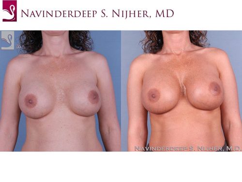 Breast Revisions Case #41991 (Image 1)