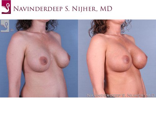 Breast Revisions Case #41991 (Image 2)