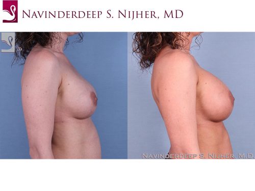 Breast Revisions Case #41991 (Image 3)