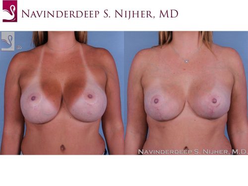 Breast Revisions Case #44752 (Image 1)