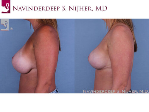 Breast Revisions Case #44752 (Image 3)