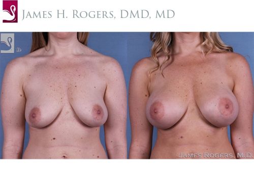 Breast Augmentation Case #47135 (Image 1)