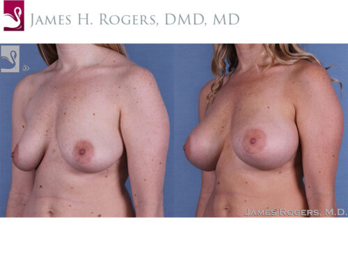 Breast Augmentation Case #47135 (Image 2)