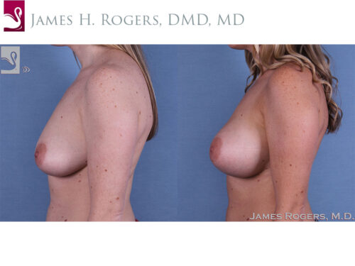 Breast Augmentation Case #47135 (Image 3)