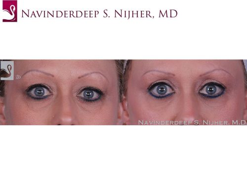 Eyelid Surgery Case #47153 (Image 1)
