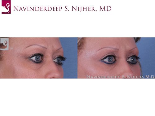 Eyelid Surgery Case #47153 (Image 2)