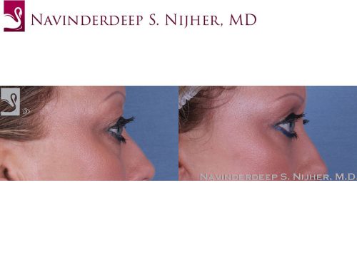 Eyelid Surgery Case #47153 (Image 3)