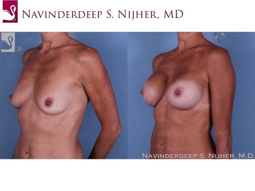 Breast Augmentation Case #48557 (Image 2)