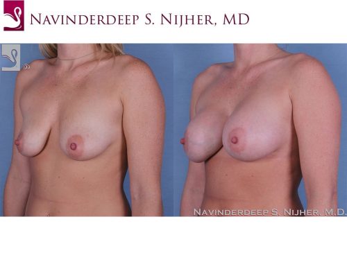 Breast Augmentation Case #51944 (Image 2)