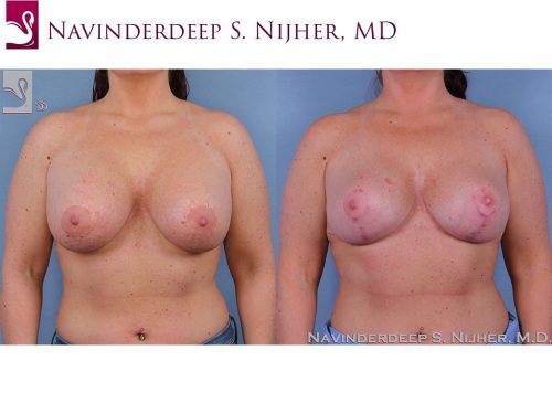 Breast Revisions Case #52180 (Image 1)