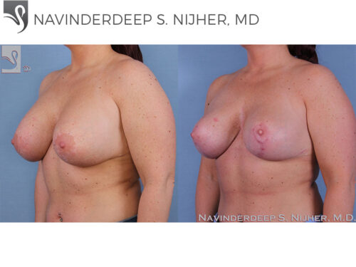 Breast Revisions Case #52180 (Image 2)