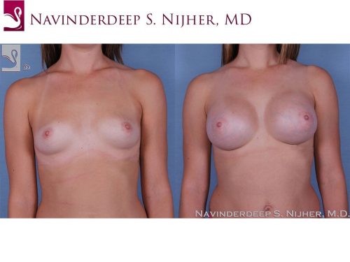 Breast Augmentation Case #53845 (Image 1)
