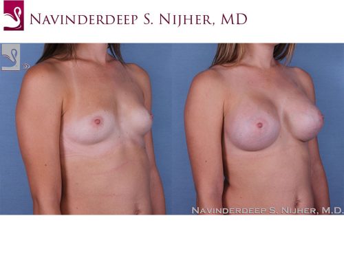 Breast Augmentation Case #53845 (Image 2)