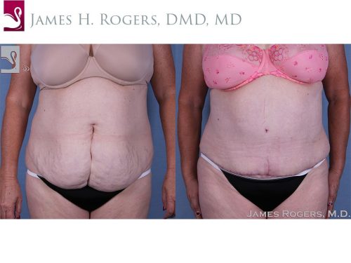 Before and after image of a real plastic surgery procedure performed by Dr. Rogers.