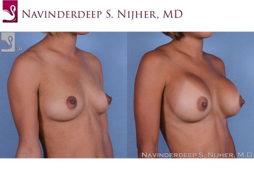Breast Augmentation Case #55028 (Image 2)