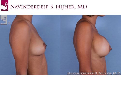 Breast Augmentation Case #55028 (Image 3)