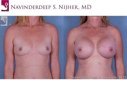 Breast Augmentation Case #56127 (Image 1)