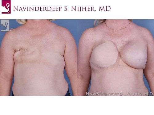 Breast Reconstruction Case #56719 (Image 1)