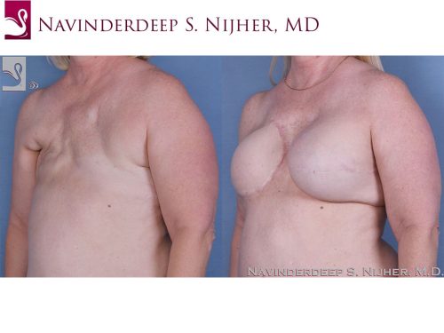 Breast Reconstruction Case #56719 (Image 2)