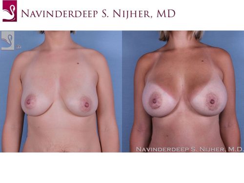 Breast Augmentation Case #57354 (Image 1)