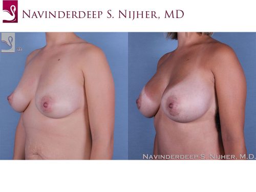 Breast Augmentation Case #57354 (Image 2)