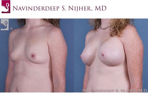 Breast Augmentation Case #57646 (Image 2)