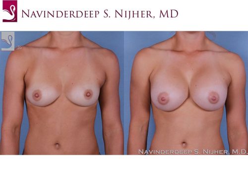 Breast Augmentation Case #58290 (Image 1)