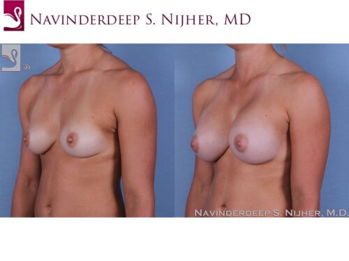 Breast Augmentation Case #58290 (Image 2)
