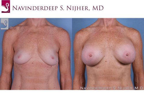 Breast Augmentation Case #59437 (Image 1)
