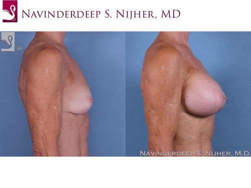 Breast Augmentation Case #59437 (Image 3)