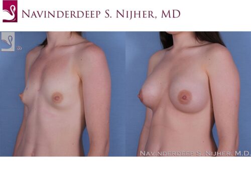 Breast Augmentation Case #59700 (Image 2)
