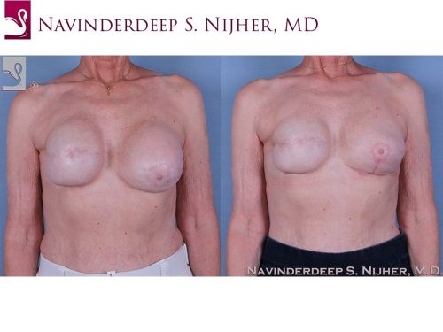 Breast Reconstruction Case #60006 (Image 1)