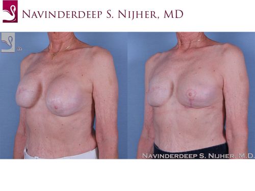 Breast Reconstruction Case #60006 (Image 2)
