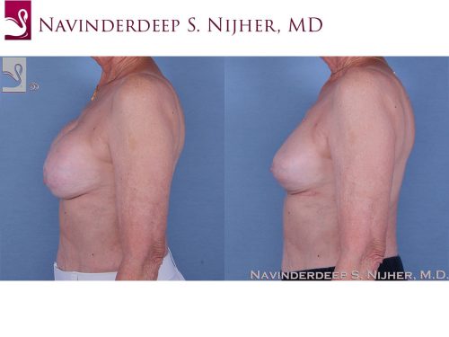 Breast Reconstruction Case #60006 (Image 3)