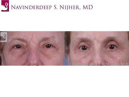Eyelid Surgery Case #60034 (Image 1)