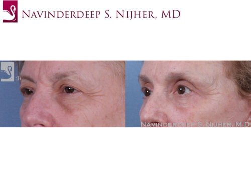 Eyelid Surgery Case #60034 (Image 2)