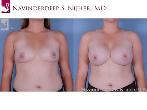 Breast Augmentation Case #60216 (Image 1)