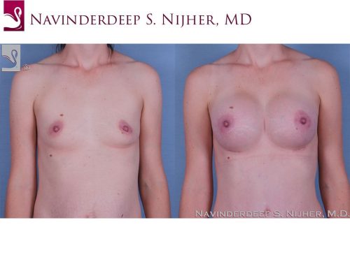 Breast Augmentation Case #60351 (Image 1)