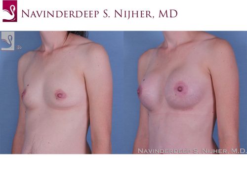 Breast Augmentation Case #60351 (Image 2)