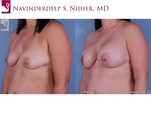 Breast Augmentation Case #60389 (Image 2)