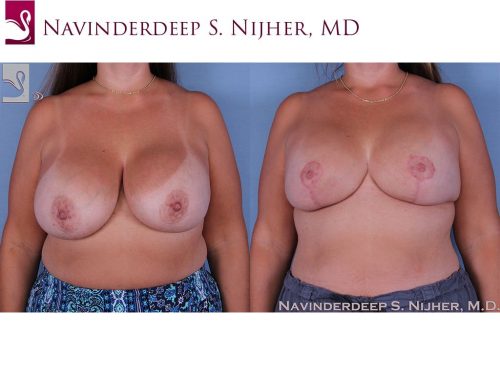 Breast Revisions Case #60567 (Image 1)