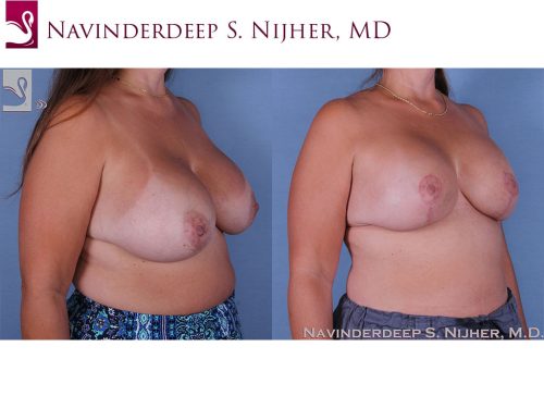 Breast Revisions Case #60567 (Image 2)