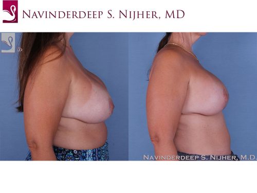 Breast Revisions Case #60567 (Image 3)
