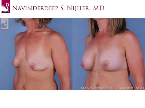 Breast Augmentation Case #60724 (Image 2)