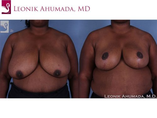 Female Breast Reduction Case #60754 (Image 1)