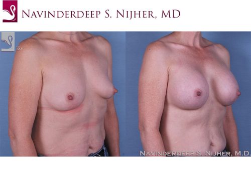 Breast Augmentation Case #60761 (Image 2)