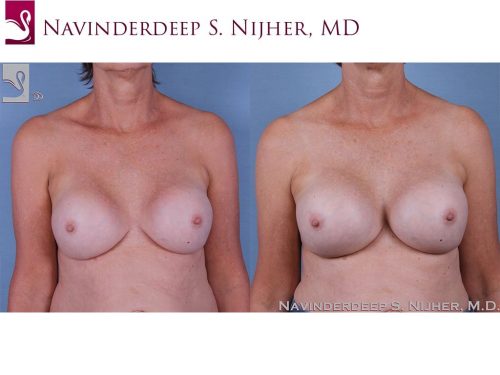Breast Revisions Case #60881 (Image 1)
