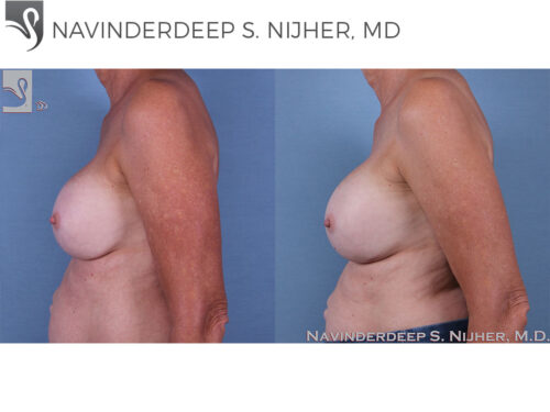 Breast Revisions Case #60881 (Image 3)